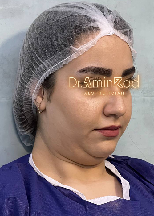 Blepharoplasty-nemone-03
