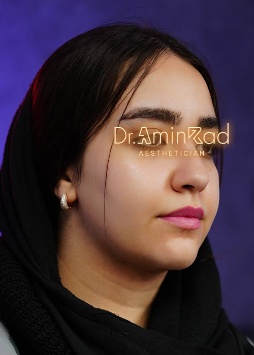 Blepharoplasty-nemone-04