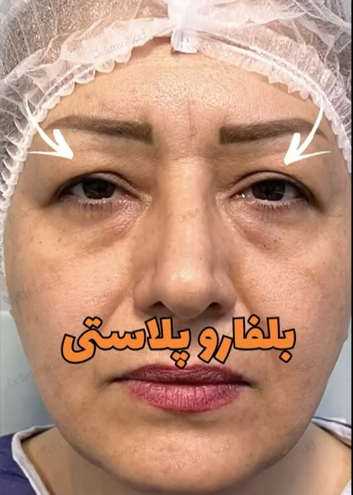 Blepharoplasty-nemone-05