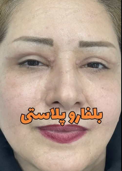 Blepharoplasty-nemone-06