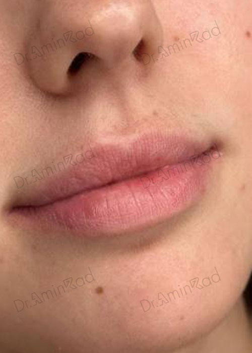 filler-lip-02