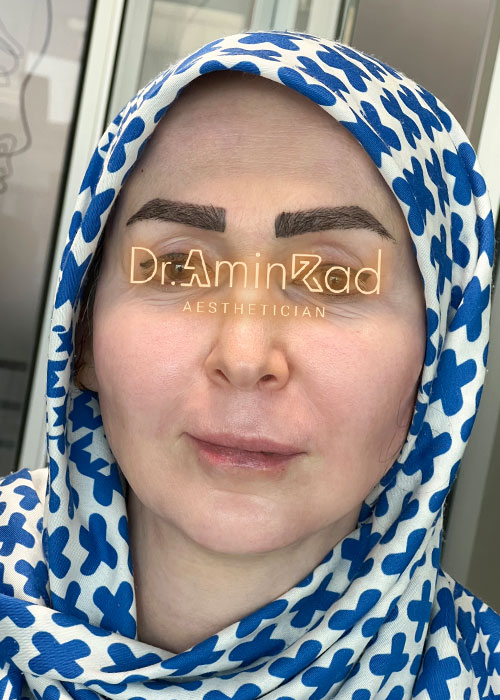 lift-nakh-nemone-01