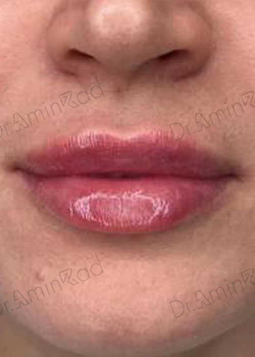 lip-filler-0