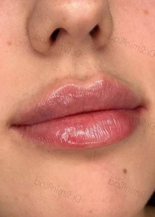 lip-filler-01