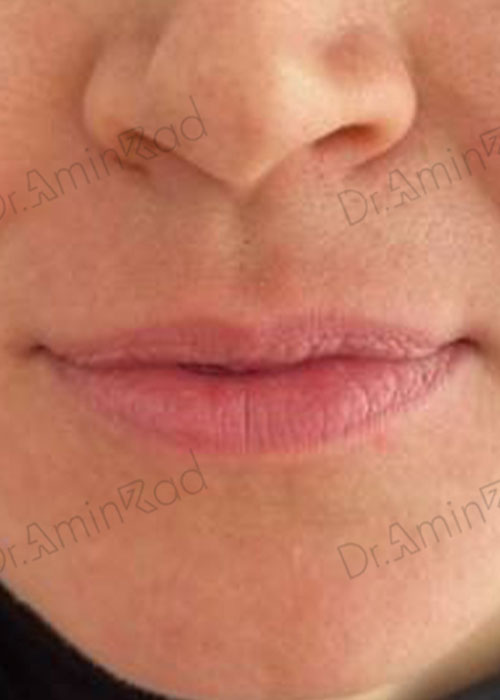 lip-filler-04