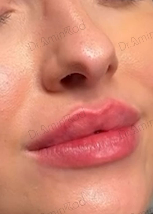 lip-filler-05