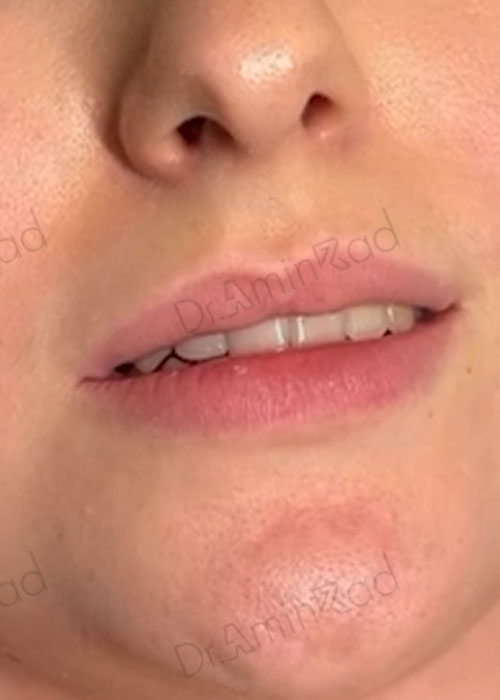 lip-filler-06